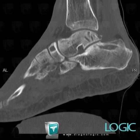 Kaposi sarcoma, Talus, Navicular, CT