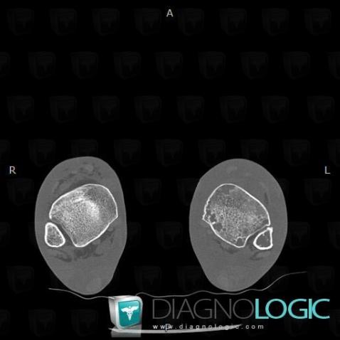 Kaposi sarcoma, Tibia - Distal part, CT