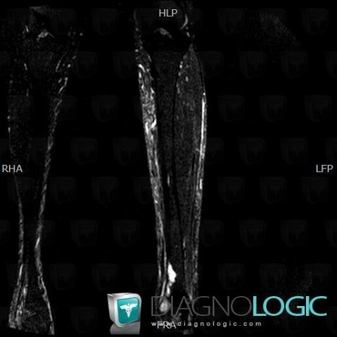 Kaposi sarcoma, Tibia - Distal part, MRI