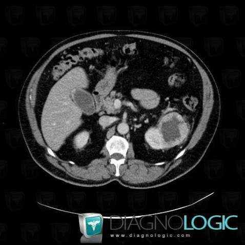 Kidney cancer, Kidney, CT