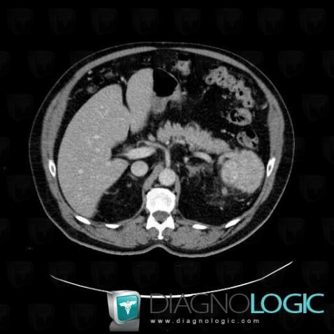 Kidney cancer, Kidney, CT