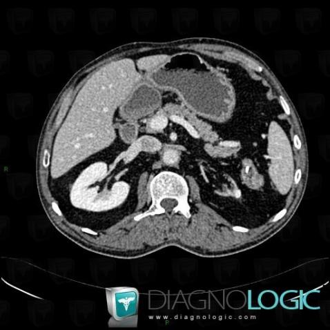 Kidney cancer, Kidney, CT