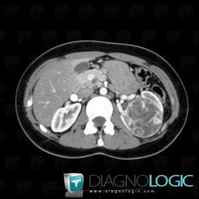 Kidney cancer, Kidney, CT