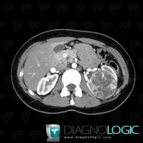 Kidney cancer, Kidney, CT