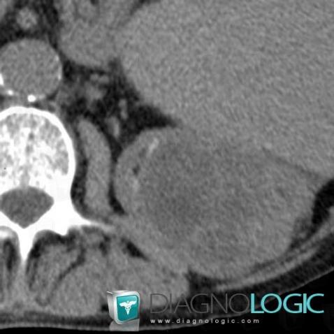 Kidney cancer, Kidney, CT