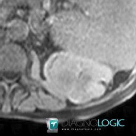 Kidney cancer, Kidney, MRI