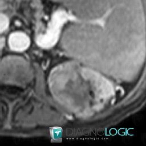 Kidney cancer, Kidney, MRI