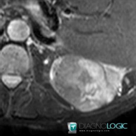 Kidney cancer, Kidney, MRI