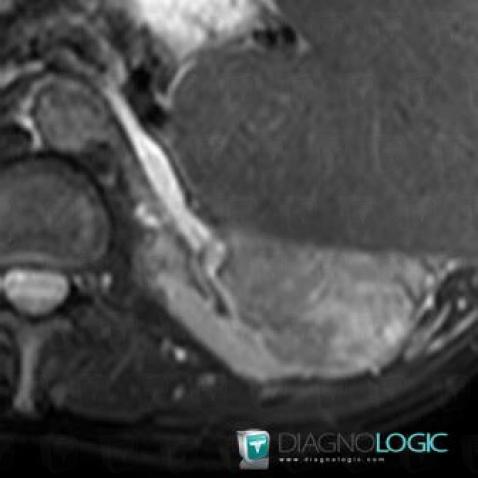 Kidney cancer, Kidney, MRI