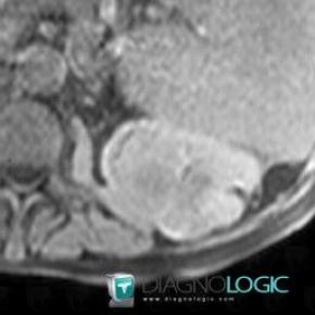 Kidney cancer, Kidney, MRI