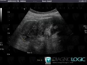 Kidney cancer, Kidney, US