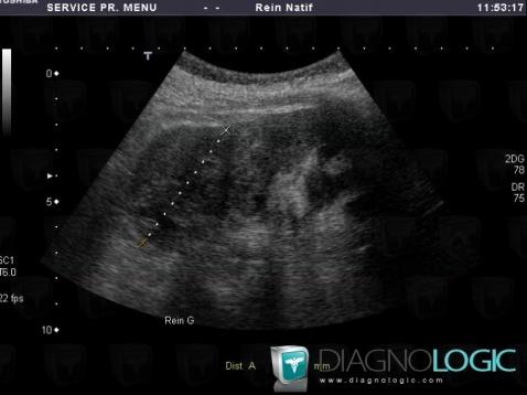 Kidney cancer, Kidney, US