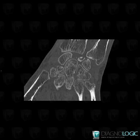 Kienböck disease, Lunate, CT