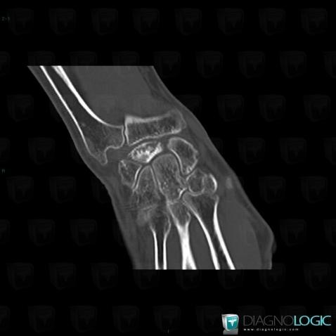 Kienböck disease, Lunate, CT