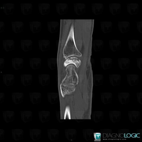 Kienböck disease, Lunate, CT