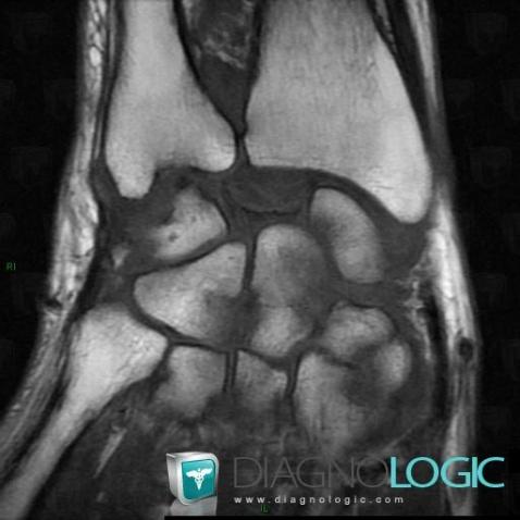 Kienböck disease, Lunate, MRI
