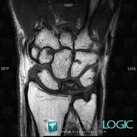 Kienböck disease, Lunate, MRI