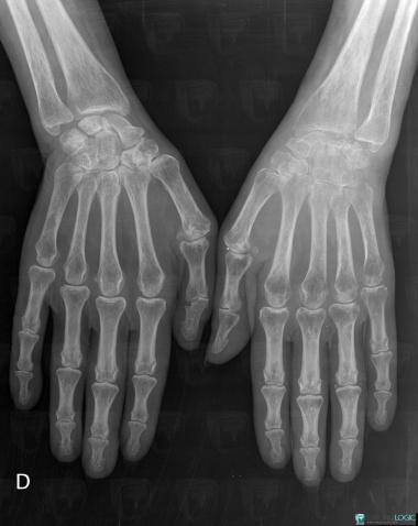 Kienböck disease, Lunate, X rays
