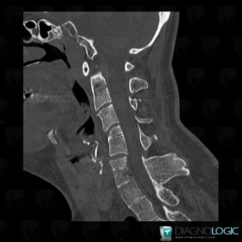 Klippel-Feil syndrome, Vertebral body / Disk, CT