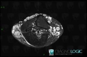 Klippel-Trenaunay syndrome, Other soft tissues/nerves - Knee, MRI
