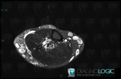 Klippel-Trenaunay syndrome, Other soft tissues/nerves - Leg, MRI