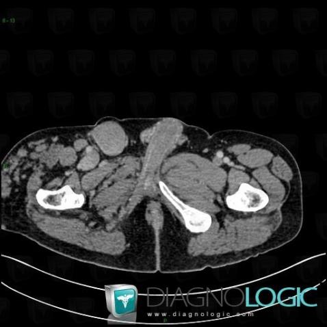 Klippel-Trenaunay syndrome, Other soft tissues/nerves - Pelvis, CT