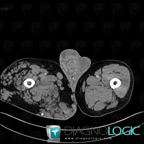 Klippel-Trenaunay syndrome, Other soft tissues/nerves - Thigh, CT