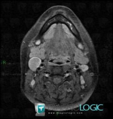 Kyste-1er arc branchial, Espaces profonds-cou, IRM