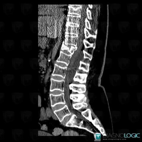 Cas radiologie Kyste arachnoïdien (Scanner ,IRM) Diagnologic