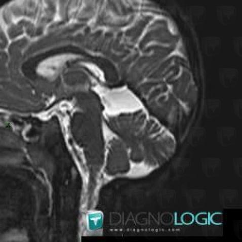 Kyste arachnoïdien, Faux-cerveau / Ligne médiane, Espaces peri cérébraux infratentoriels, IRM