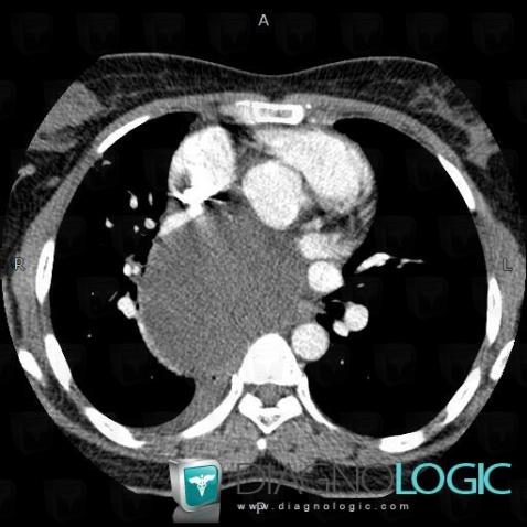 Kyste bronchogénique , Médiastin, Oesophage, Scanner