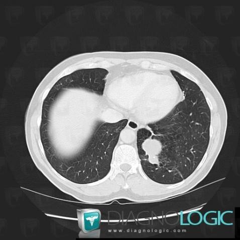 Kyste bronchogénique , Parenchyme pulmonaire, Scanner