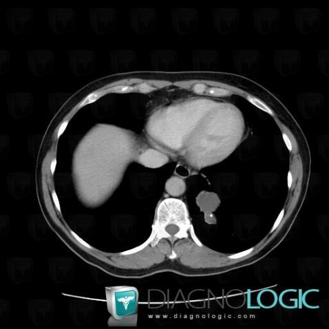 Kyste bronchogénique , Parenchyme pulmonaire, Scanner