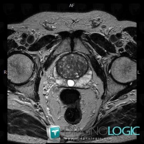 Kyste-canal-Müller, Prostate, IRM