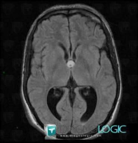 Kyste colloïde, Hémisphères cérébraux, Ventricules / Région périventriculaire, IRM