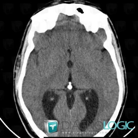 Kyste colloïde, Hémisphères cérébraux, Ventricules / Région périventriculaire, Scanner