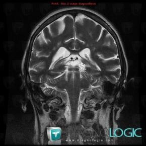 Lesion Kystique Intracerebrale Diagnologic