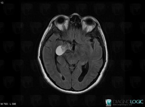 Kyste dermoïde, Hémisphères cérébraux, Hypophyse et région parasellaire, IRM