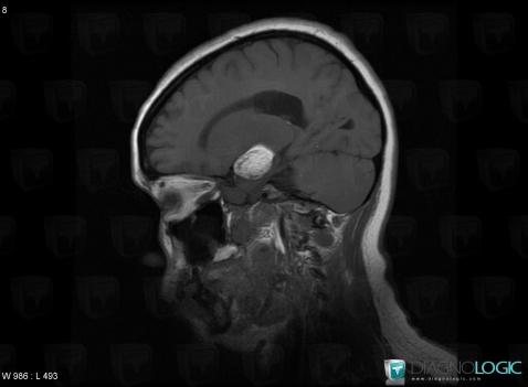 Kyste dermoïde, Hémisphères cérébraux, IRM