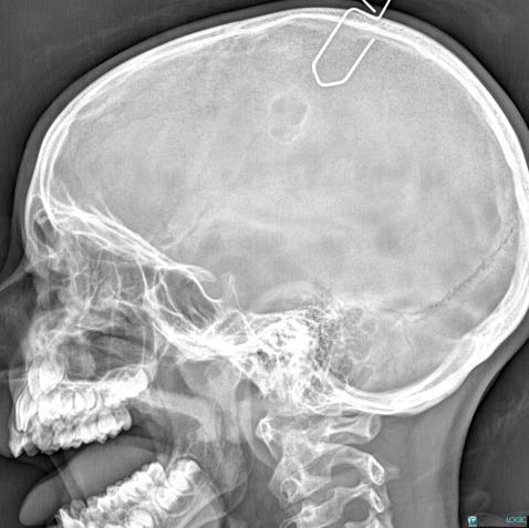 Kyste dermoïde, Voute-crâne, Radio