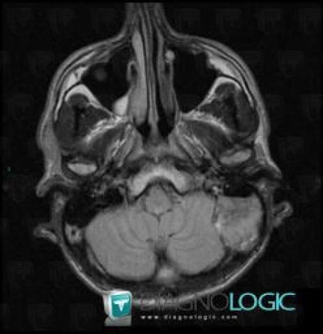 Kyste épidermoïde , Espaces peri cérébraux infratentoriels, Fosse postérieure, IRM