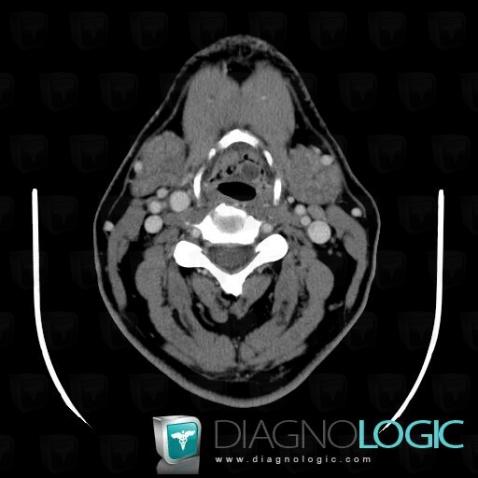 Kyste épiglottique, Larynx, Scanner