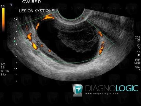 Kyste fonctionnel hémorragique, Annexe / Ovaire - trompe, Pelvis / Périnée, Echographie