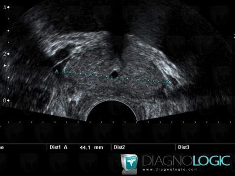 Kyste-l'utricule, Prostate, Echographie