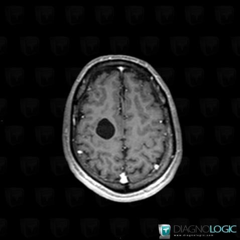 Kyste neuroglial, Hémisphères cérébraux, IRM