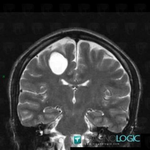 Kyste neuroglial, Hémisphères cérébraux, IRM