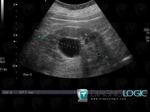 Kyste parapyélique, Rein, Echographie