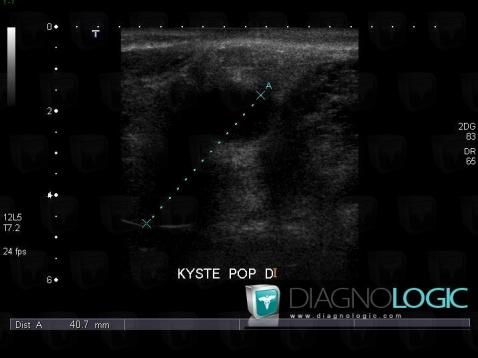 Cas radiologie : Kyste poplité (Echographie) - Diagnologic