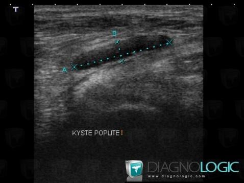 Kyste poplité, Autres parties molles/nerfs - Genou, Echographie