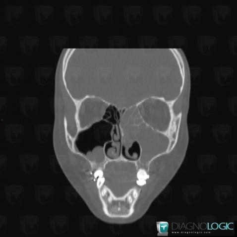 Kyste sous muqueux, Sinus, Scanner